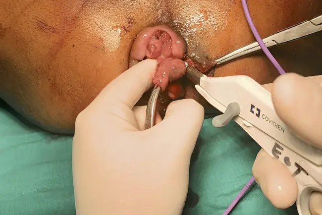 Open Surgery